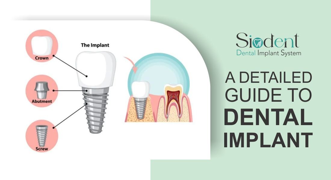 A Detailed Guide to Dental Implants