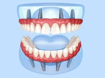 All Four Dental Implants