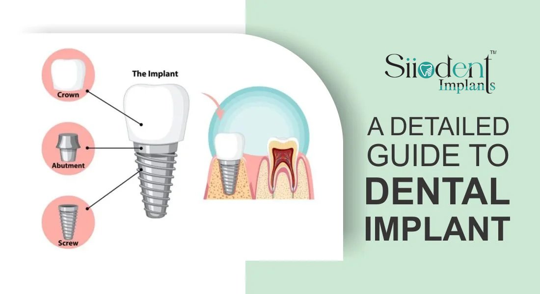 Guide-to-Dental-Implants