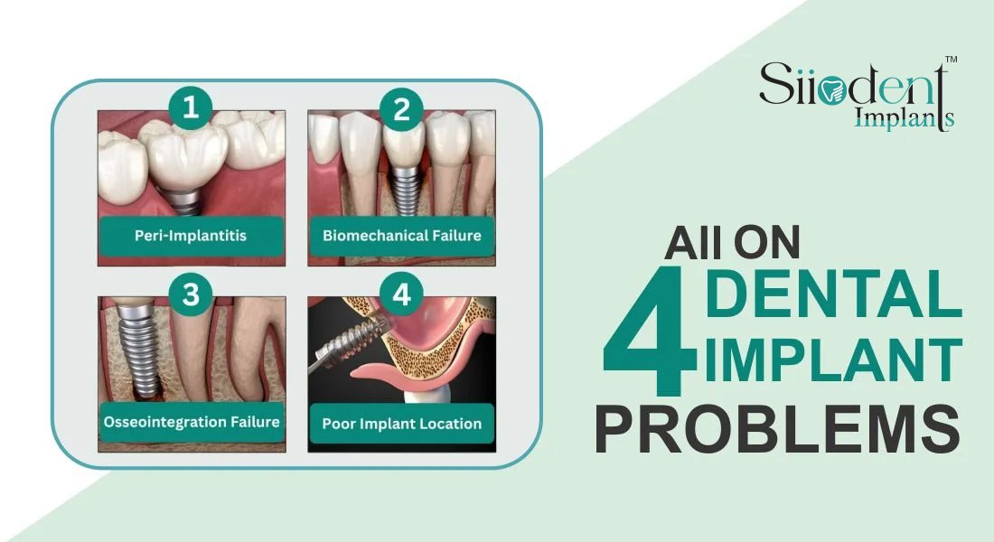 What-Are-the-Problems-with-All-on-4-Dental-Implants